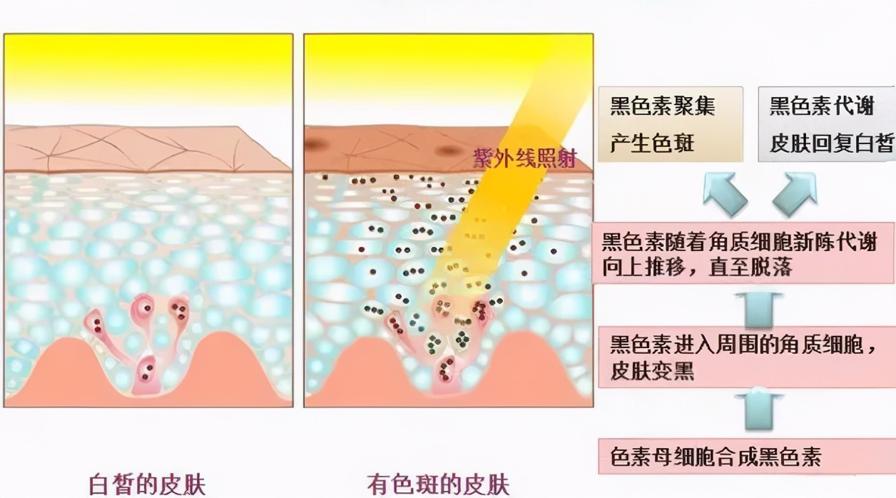 【黑色素的生成和代谢】4,遗传因素遗传是雀斑发病的主要因素,为常