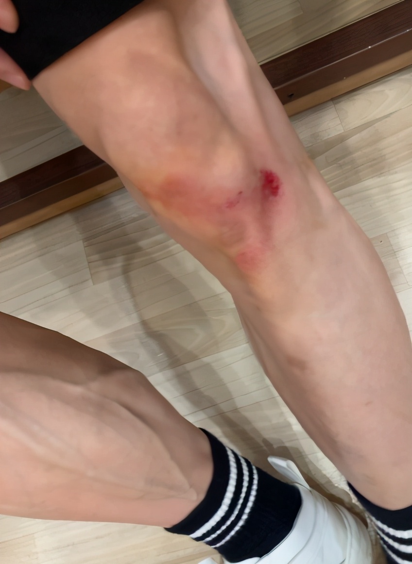 照片中,张一山的膝盖上出现了大片淤青和血迹,看起来是刚把伤口清理完