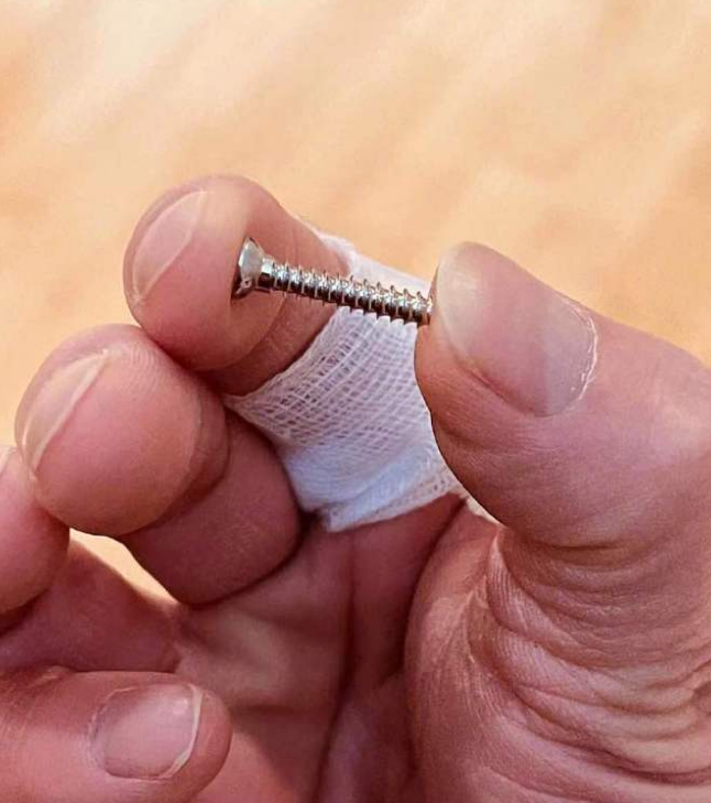 陶喆取出存在手里15年的螺丝张云雷取44枚钢钉听起来就很疼