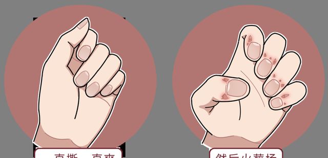 女明星手撕"倒刺",入院手术,医生提示:别乱拔,严重或致截肢