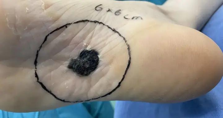 短短5个月,宁波女白领脚底的黑痣突然变大!一查竟是恶性肿瘤!