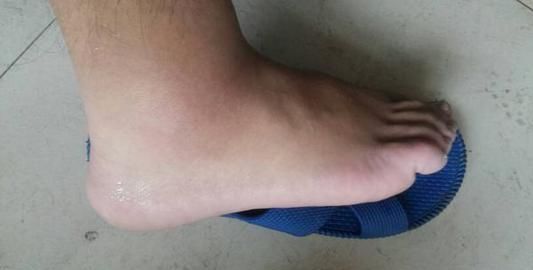 四,脚踝处水肿如果关节出现红肿,即使不痛,也要提防痛风来临.