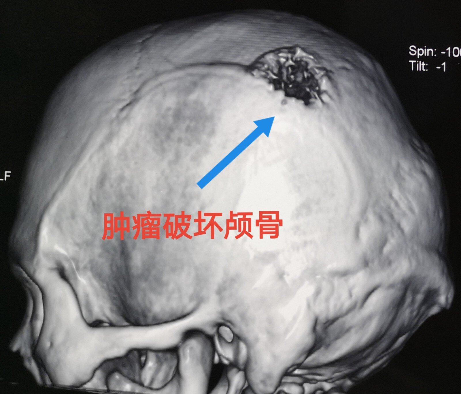 头部一个小疙瘩快速长大,一定要当心有可能是恶性转移瘤__财经头条
