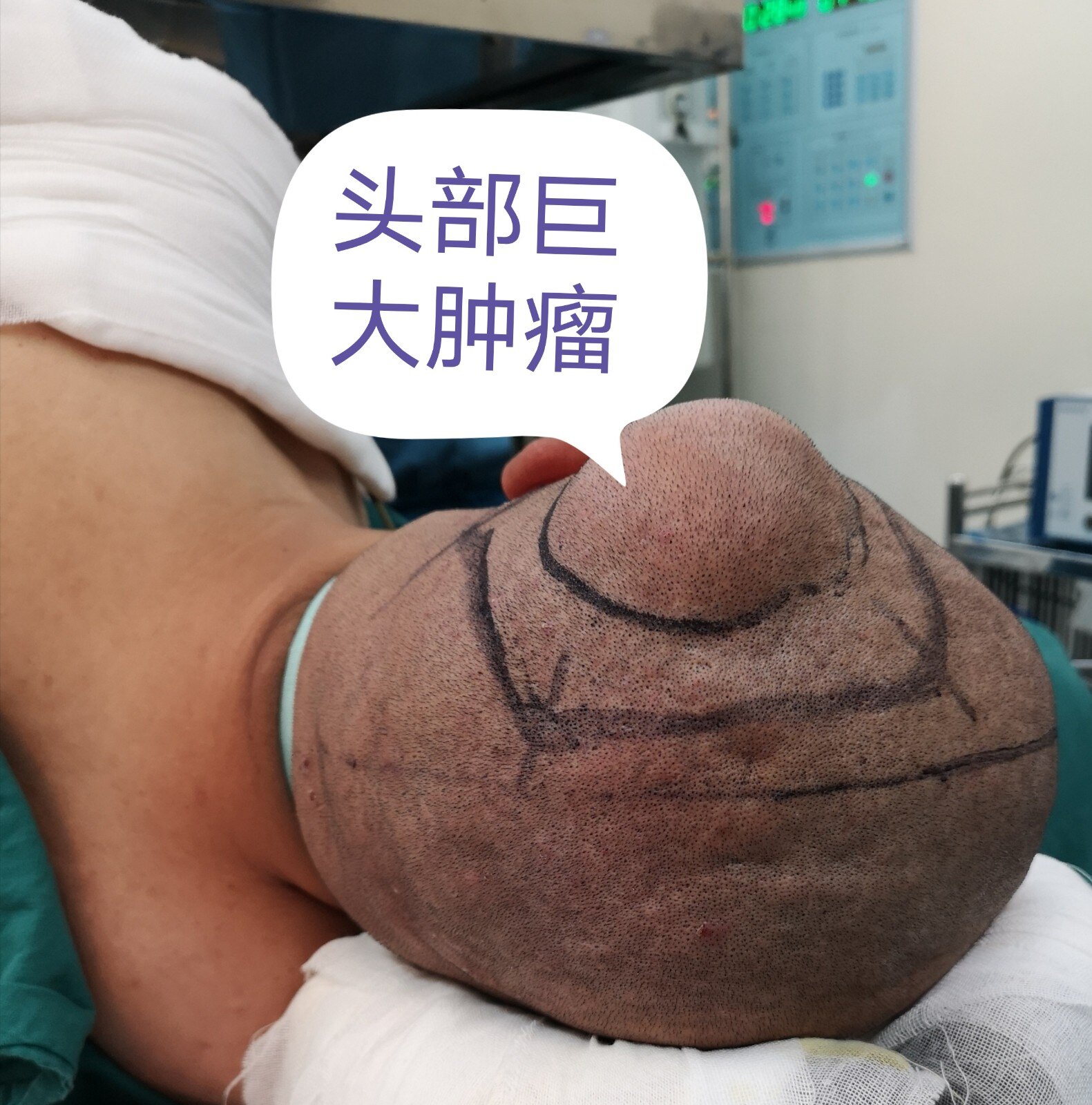 头部一个小疙瘩快速长大,一定要当心有可能是恶性转移瘤