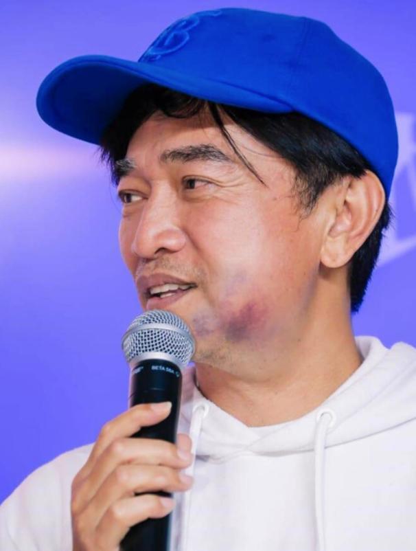 吴宗宪脸部肿胀有淤青自嘲是猪头皮当众亲w30岁的女儿惹争议