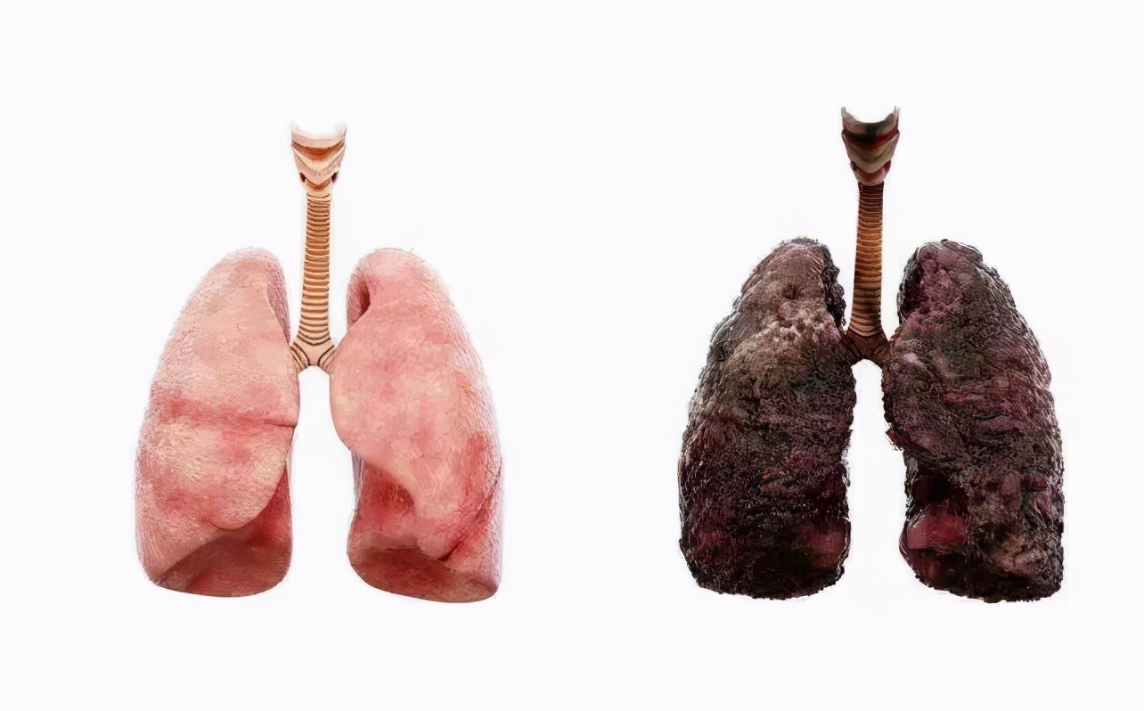 男性晨起若有4个异常,肺或已黑如焦炭,一个不占,肺还算强壮