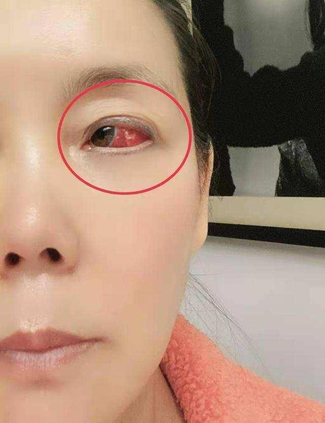 偶像剧女星林立雯视网膜破裂近视800度入院做修补手术