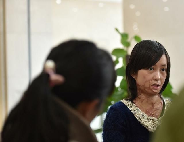 安徽16岁少女周岩因拒绝官二代被泼汽油毁容如今过得怎样了