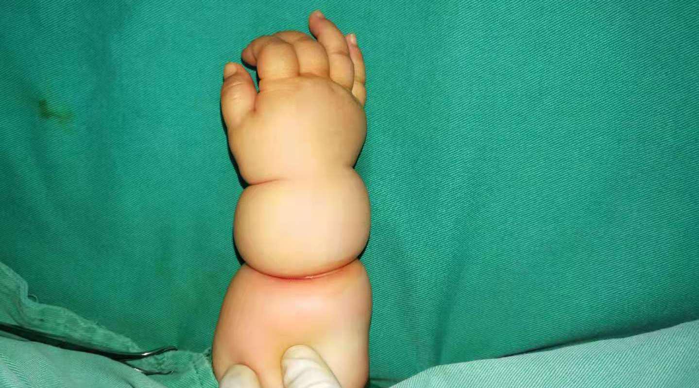 这不是肥胖,这是束带综合征!新手爸妈一定要注意区分!