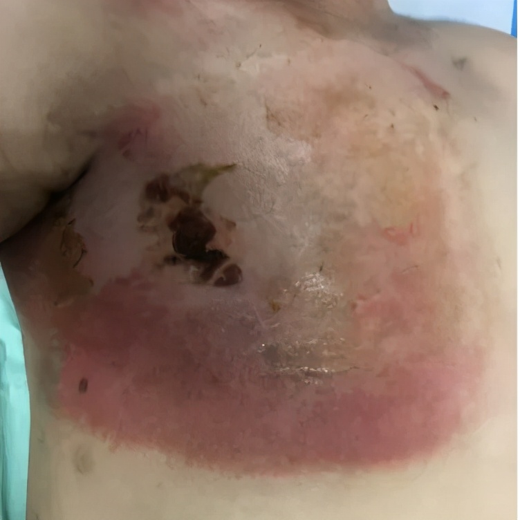 乳腺癌放疗后皮肤图片