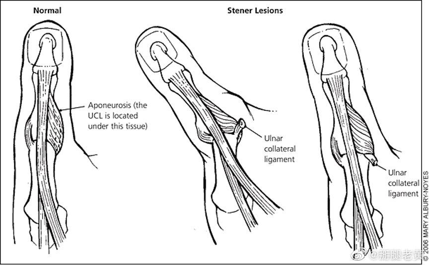 康复小知识拇指尺侧副韧带复合体损伤是滑雪者第二大常见损伤