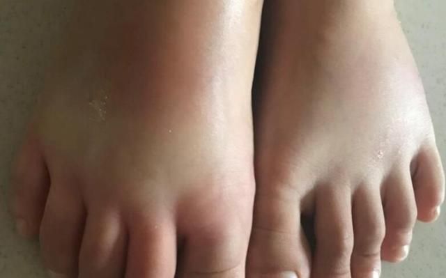 孩子被这些火蚁叮咬后,会感觉皮肤发烫,也不会迅速地发红,肿痛,孩子会