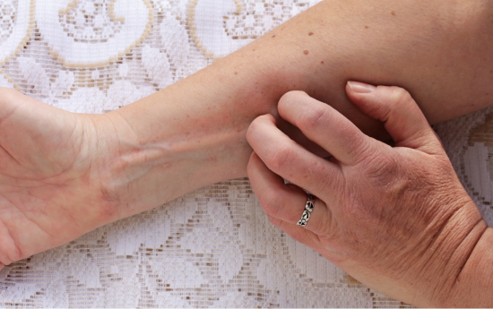 但是其实根据患者的发病原因,发病时间,皮肤特点等主要症状,湿疹被分