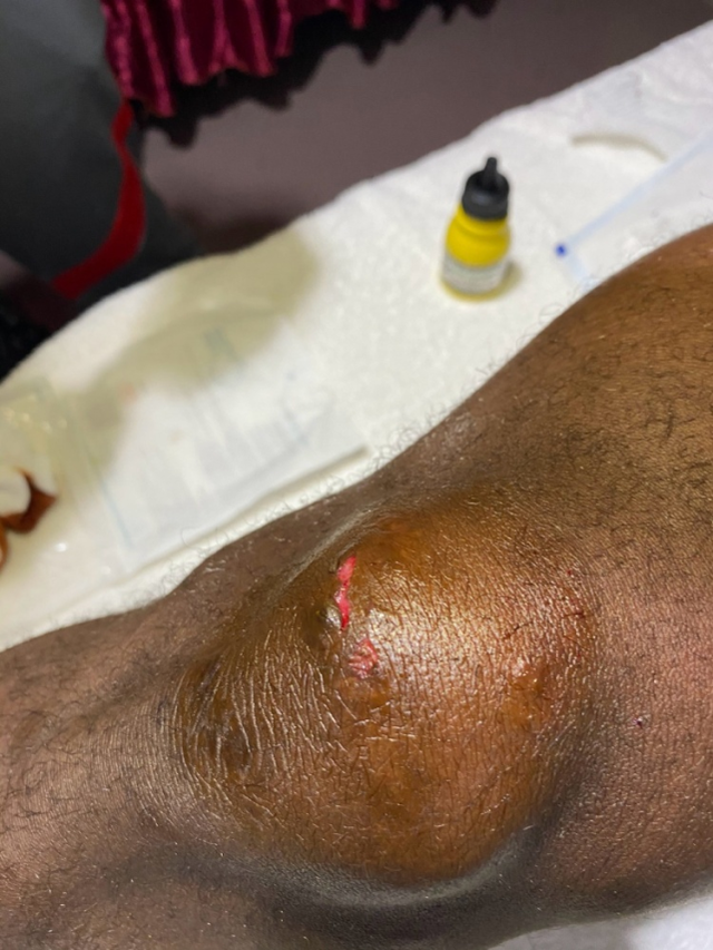 新闻官马悦赛后晒出了巴索戈的伤口图,右脚膝盖部分出现了明显的红肿