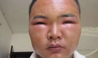 尿毒症来临前身体有4个信号需要注意