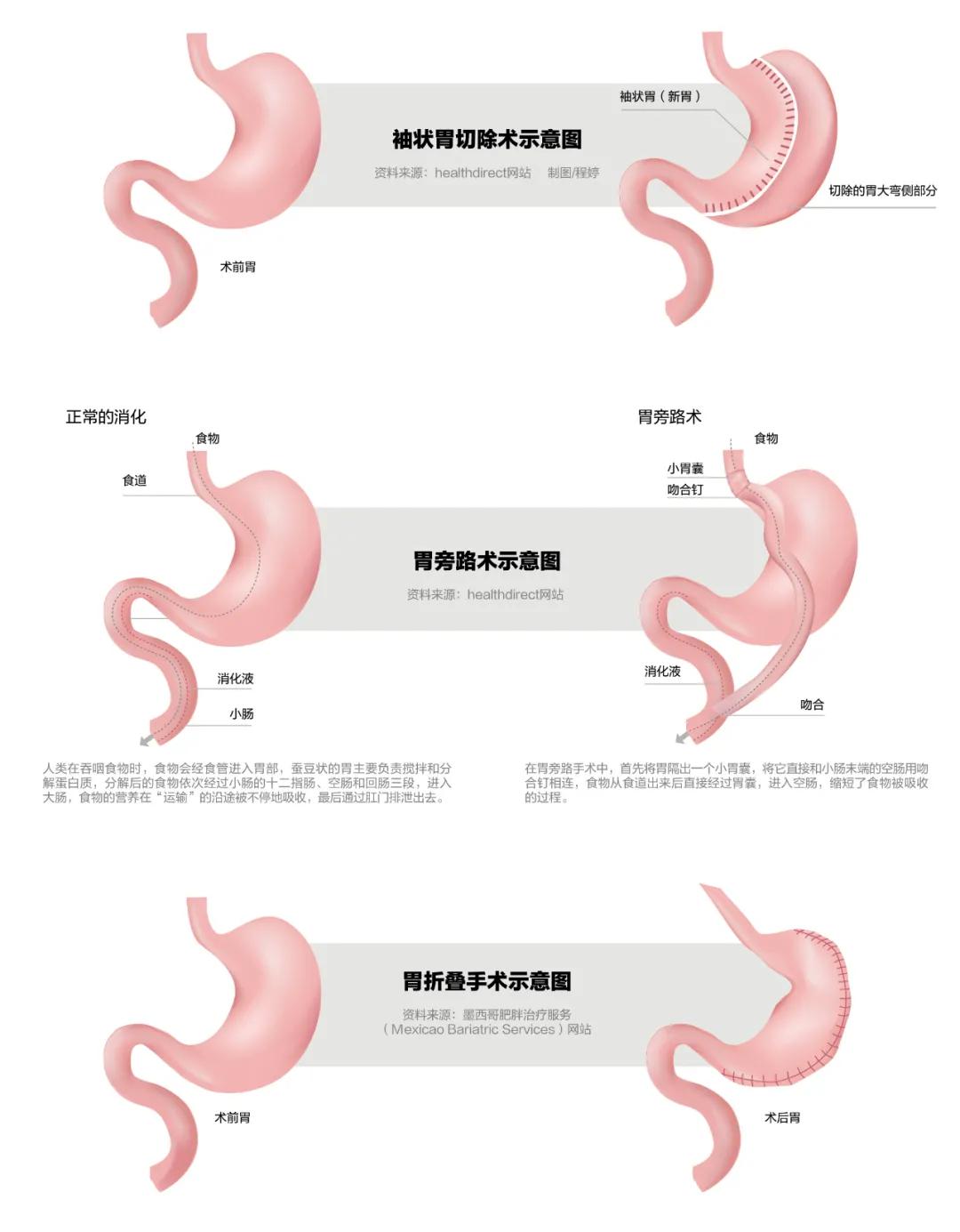 "切胃减肥"被滥用还是切得不够?|中日|手术|孟化_新浪新闻