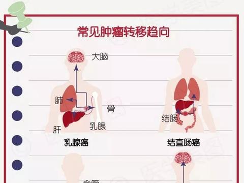 癌症转移癌细胞最容易转移至哪些部位