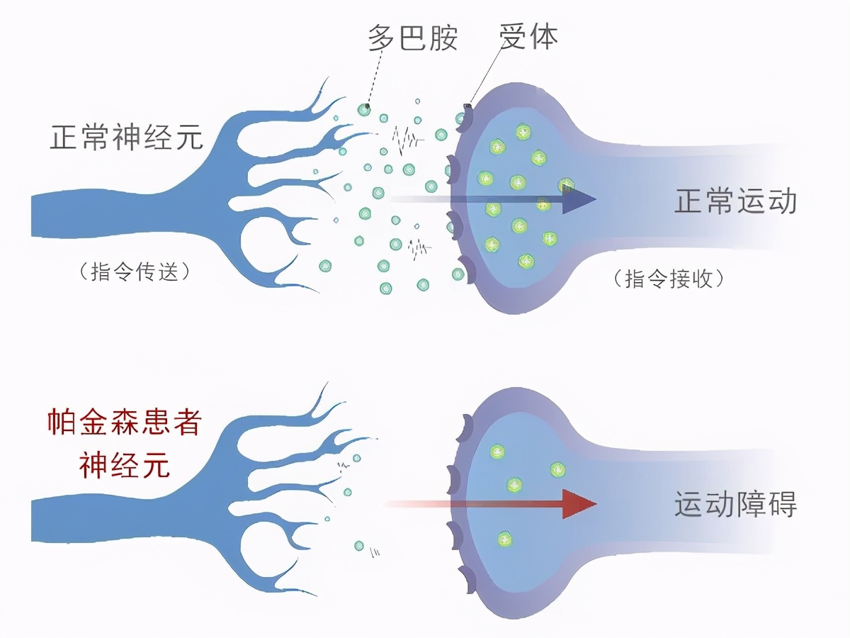 手抖就是帕金森老年人才会得年轻人儿童也要小心