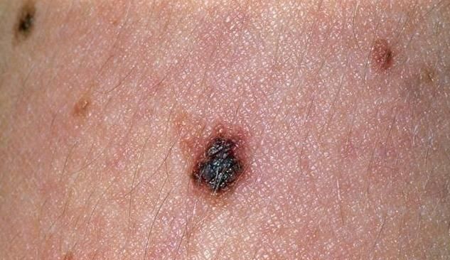 身上长出的痣,哪些需要重视?其中这4类,或许尽早排查