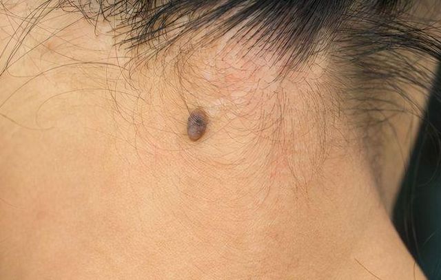 身上长出的痣,哪些需要重视?其中这4类,或许尽早排查