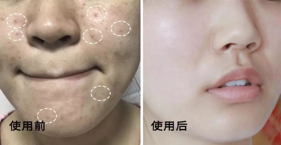 拒绝螨虫脸5秒揉一揉螨虫全出来了痘痘黑头全没了