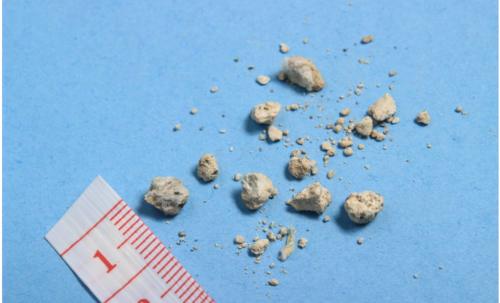 平时不痛不痒一到体检就查出肾结石是怎么回事该如何预防