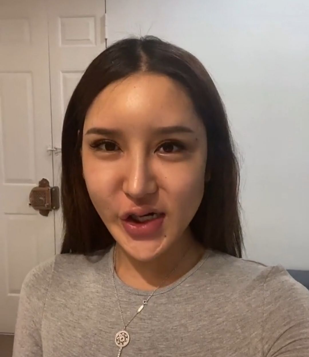 网红桃花宝宝整容又失败,额头凹陷一个大坑,整容近百次花费不菲