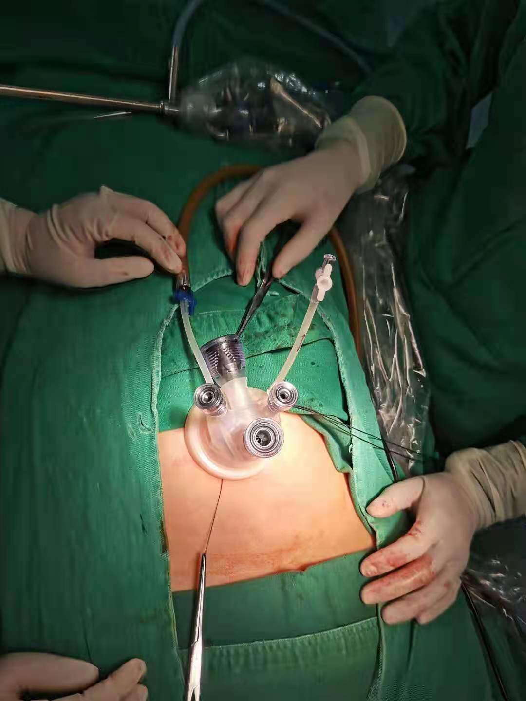 宫外孕手术微创图片图片