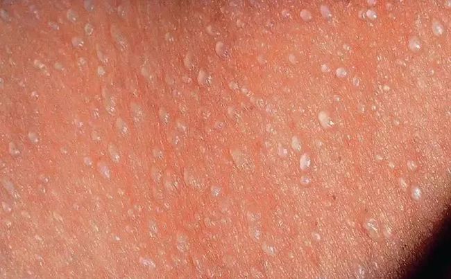 小儿推拿杨晓炎炎夏日是痱子高发季节宝宝长痱子如何预防护理