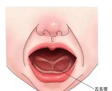 孩子说话不清晰咬音不准是舌系带过短导致的么
