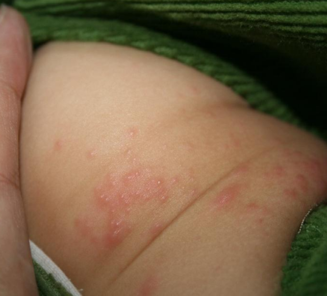 夏天尿布疹高发护理小屁屁的方法在这里为宝宝收了