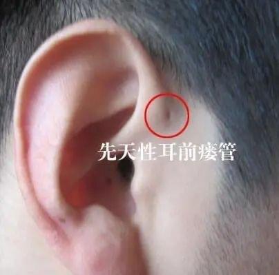 宝宝长"耳仓"就是有福气吗?