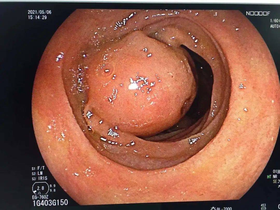 入院后,余医生为刘女士安排了内镜检查,胃镜结果示:十二指肠水平段