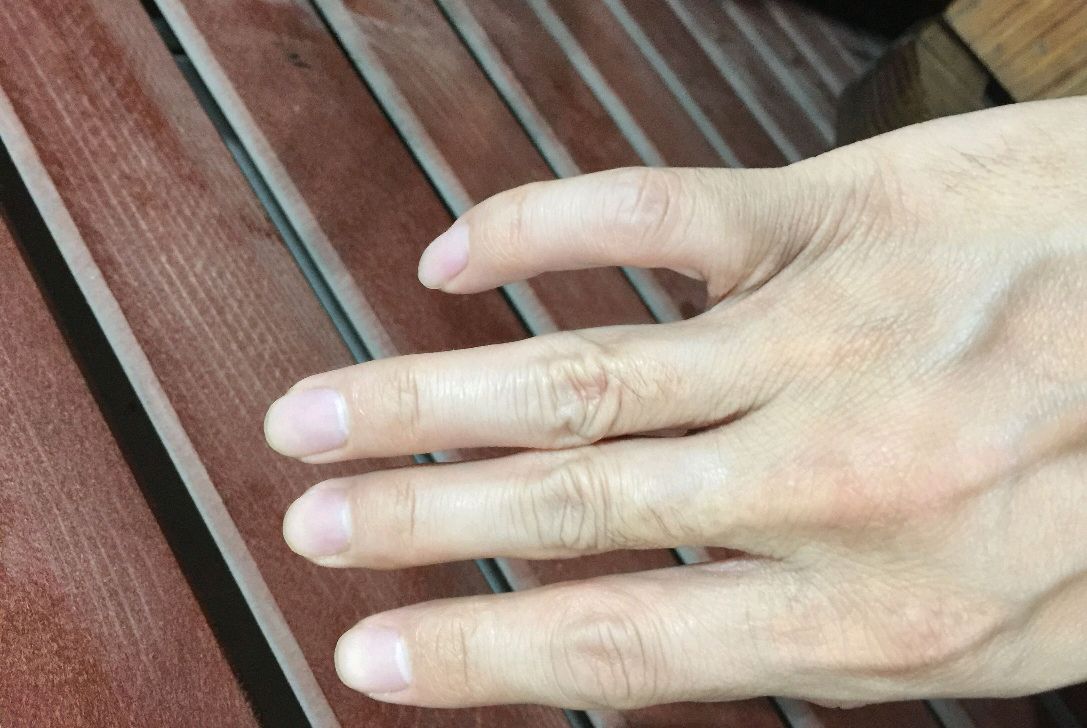 血糖高不高看手或许能知道手部出现了4个症状及早去测血糖