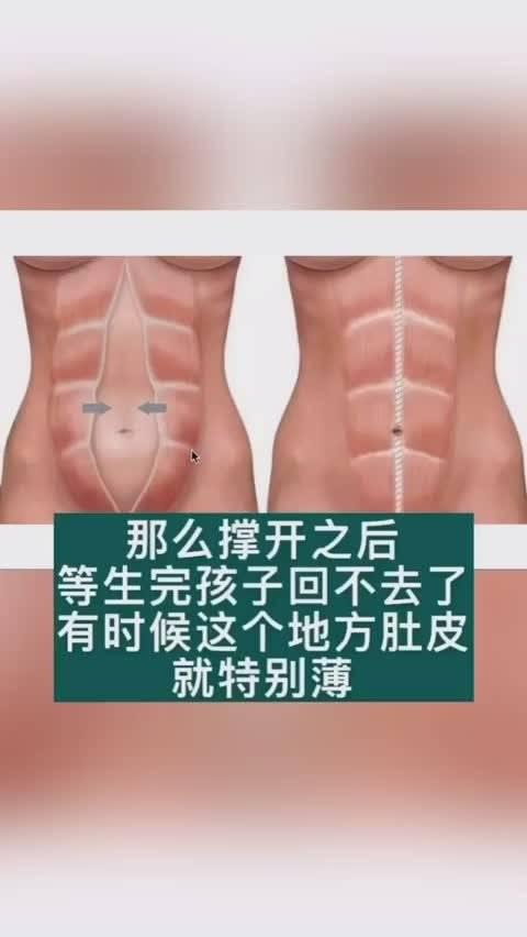 腹直肌分离怎么办?转给怀孕的她吧!