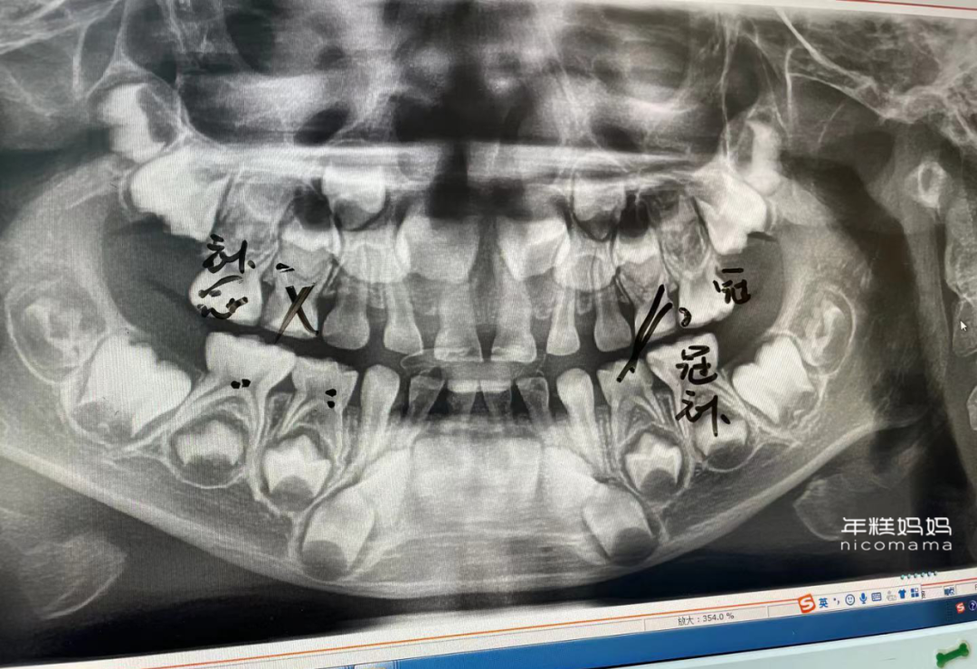 医生不建议孩子自己刷牙，竟然是因为这个！休闲区蓝鸢梦想 - Www.slyday.coM