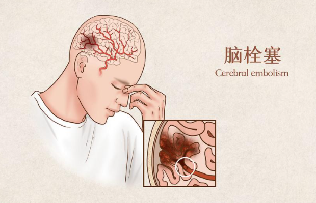 45岁男子突发脑血栓离世,医生提醒:4个异常出现,早点检查脑ct