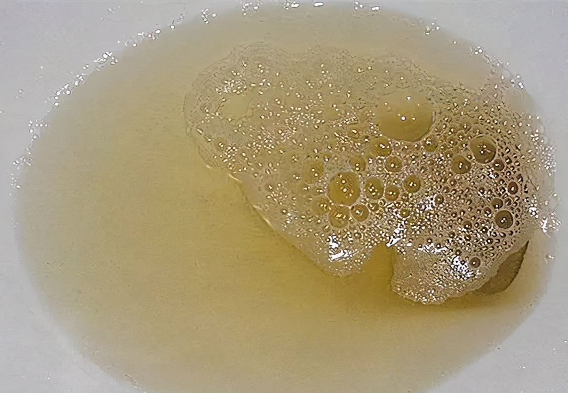 肾脏有问题,上厕所有4个表现,若一个都没有,肾脏还算强|肾脏|尿液