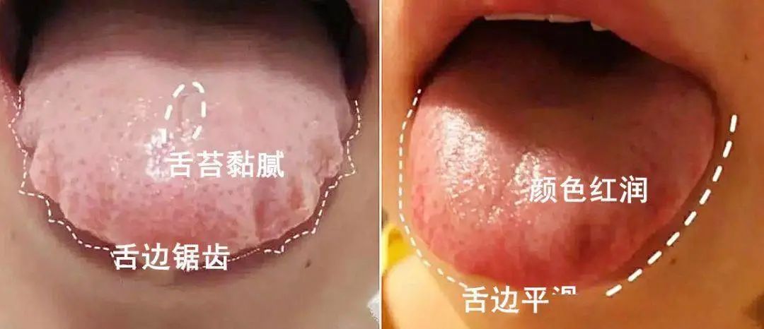 厚腻的舌苔和舌边锯齿不见了,舌头变回原本的红润,洁净,身边人也没再