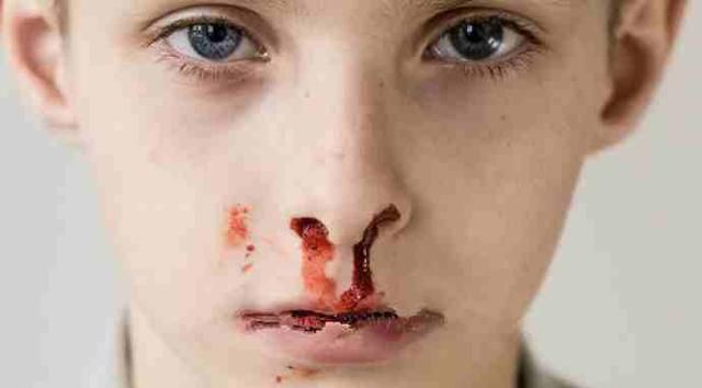 可能导致鼻出血;2,空气干燥的时候鼻黏膜也容易因为受刺激而破损出血