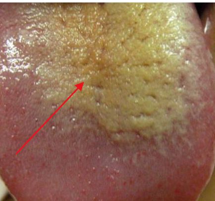 教你看舌苔颜色判断疾病,告别胃肠问题|舌苔|湿气|舌头_新浪新闻