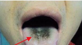 教你看舌苔颜色判断疾病告别胃肠问题