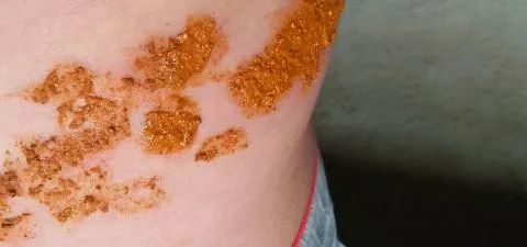 成都普济中医药研究院带状疱疹后遗神经痛怎么办