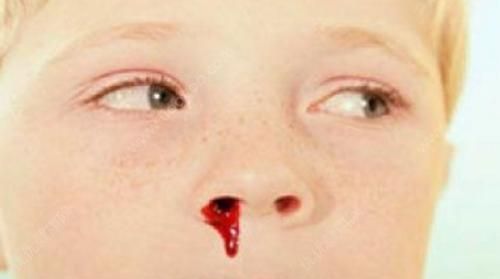 宝宝流鼻血时仰头不对吗,该怎么护理|宝宝|鼻中隔|鼻黏膜_新浪新闻