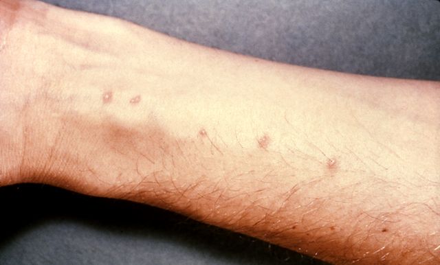 血吸虫|血吸虫病|钉螺_新浪新闻