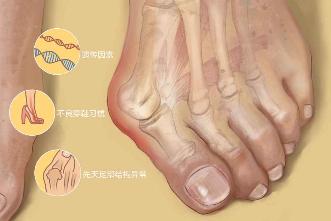 穿20年高跟鞋脚不小心变了样最爱高跟鞋的女人也不想碰它了