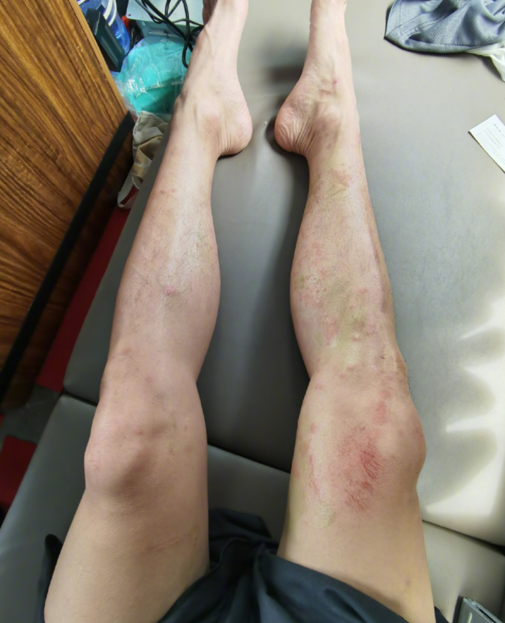 知名男星陈学冬被水母蜇伤大腿伤口密密麻麻一片红疤触目惊心