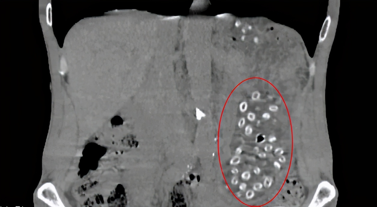 生吞近200颗杨梅核!胃里密密麻麻…男子紧急送医后竟查出恶性肿瘤休闲区蓝鸢梦想 - Www.slyday.coM