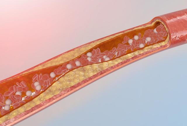 血压较高,可以补充点利维三素,其中的活性成分可以帮助恢复血管弹性