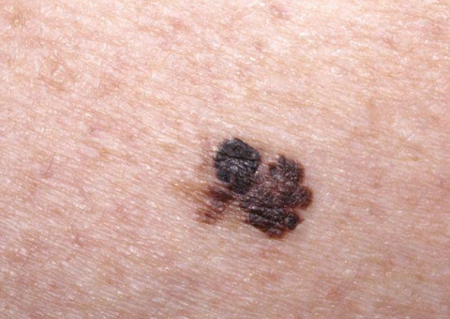 如果身上出现这种痣要注意一下了或许不是普通痣